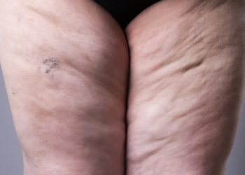 A felesleges zsírraktározás tünetei: 7 jel, ami lipödémára utalhat – cikkajánló: femina.hu