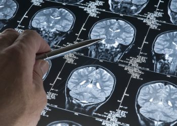 Alzheimer-kór korai jele friss kutatás alapján – cikkajánló: femina.hu